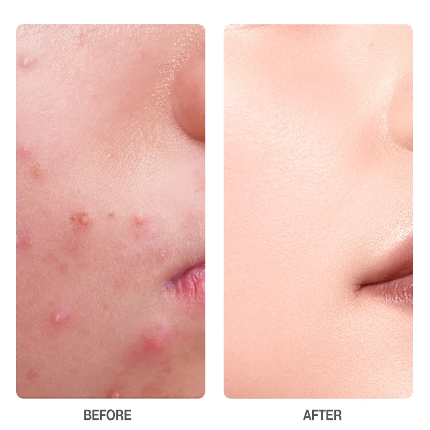 Skinever SALICYLIC ACID Refreshing ACNE SOAP 80g